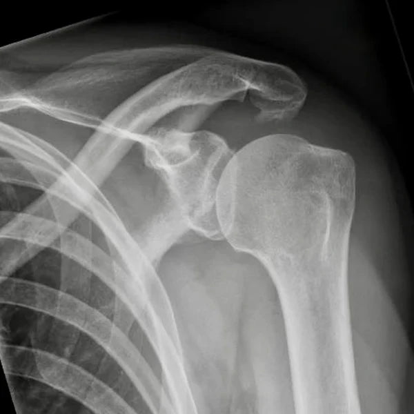 Conflit sous-acromial
